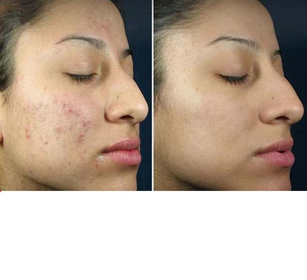 شوینده سالیسیلیک اسید کوزارکس